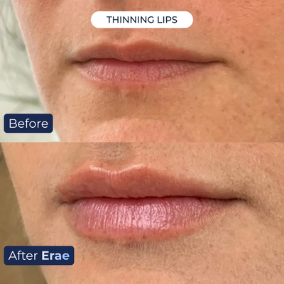 Erae™ Bio-Infusion